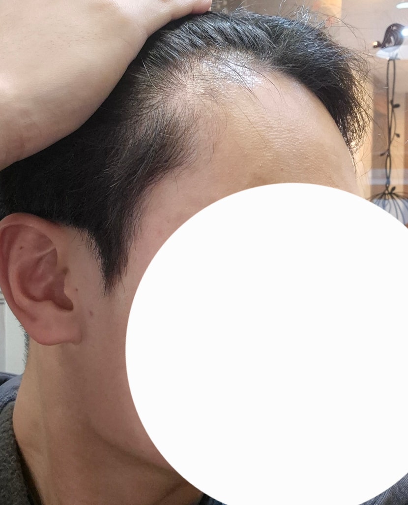 0일차 수술 전 측면샷