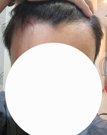 0일차 수술 전 정면샷