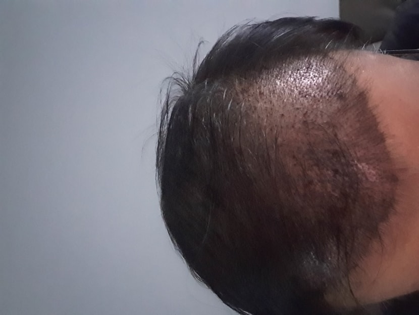 수술7일차