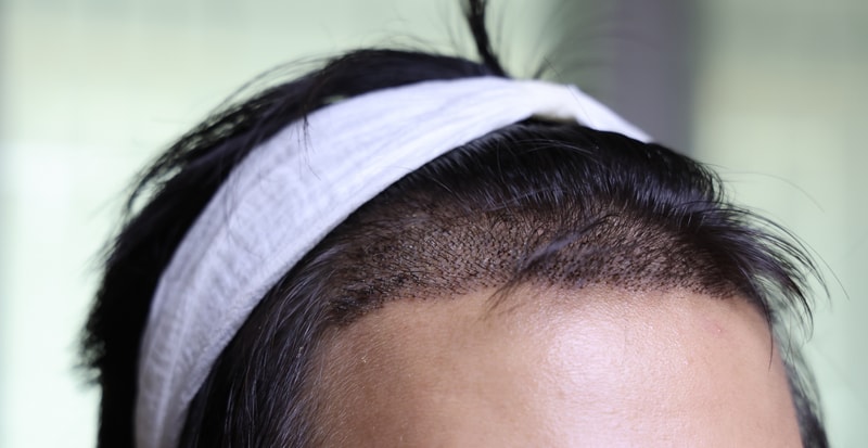 5년간의 공부 끝에 이번에 모발이식을 받았습니다! 무엇이든지 질문해주세요! 성심껏 답변해드릴게여!