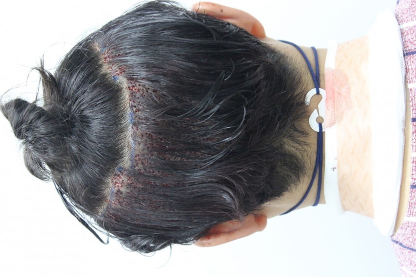 수술직후 뒤통수