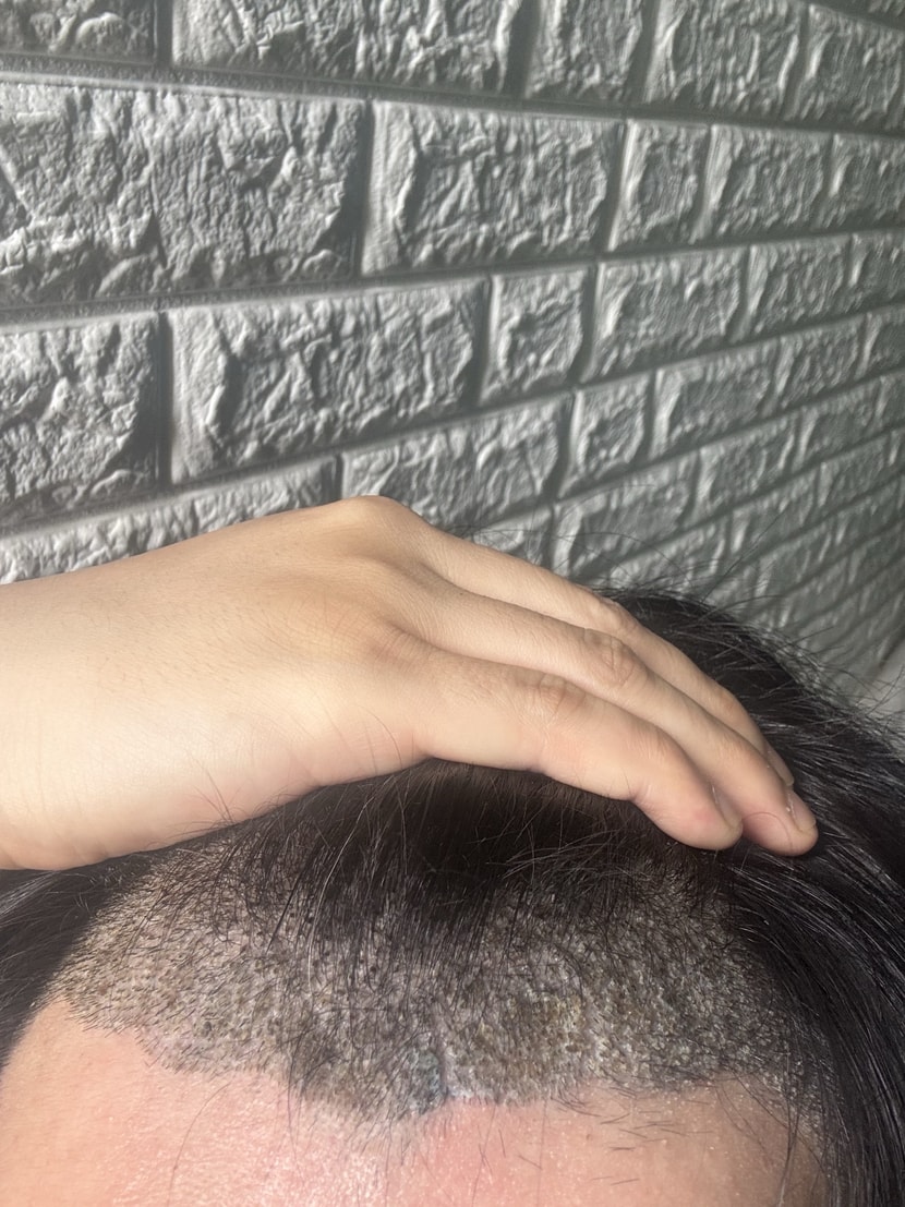 10일차 갈라짐과 동시에 이식모 탈락인줄 ..