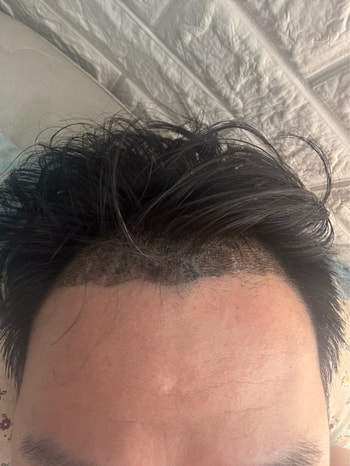 8일차 슬슬 뭔가 이식부위에 흰색? 군데군데 뭔가가 갈라지네요 ..