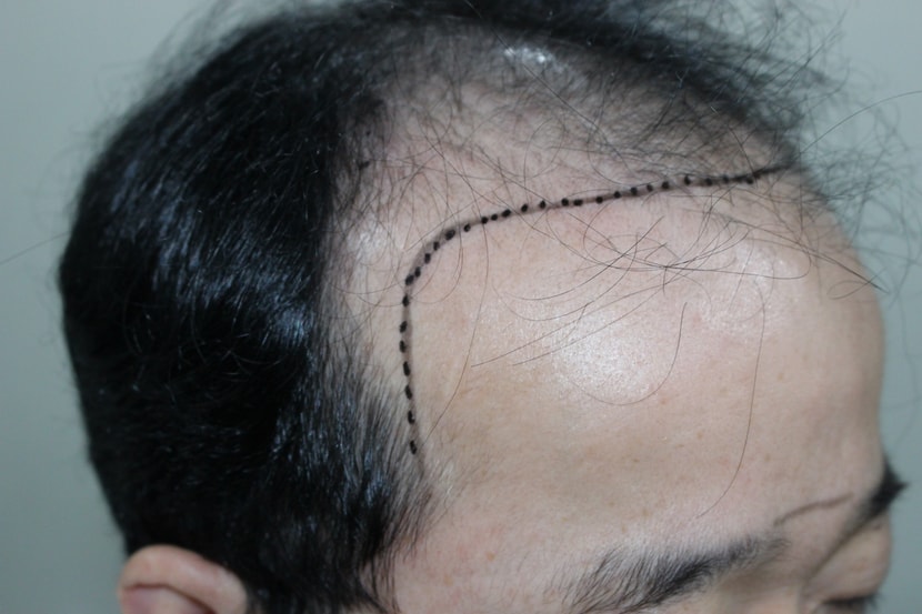 수술전 1