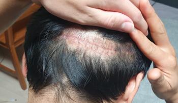 34일차 절개봉합부 모발 탈락 사진