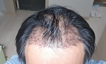 34일차 이식부 사진