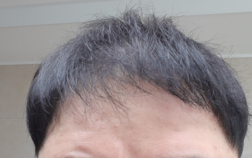 2200모낭 10개월경과