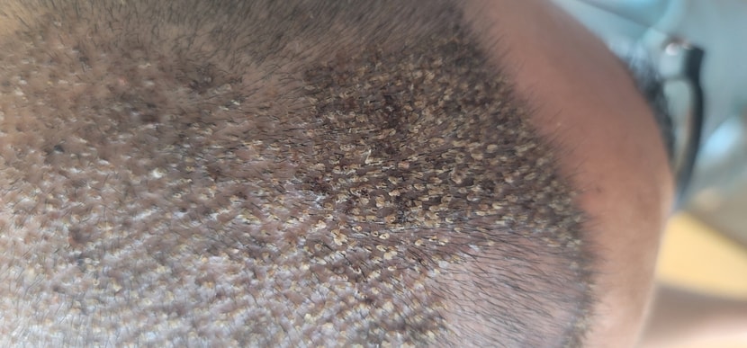 이식한 부위 사진 1