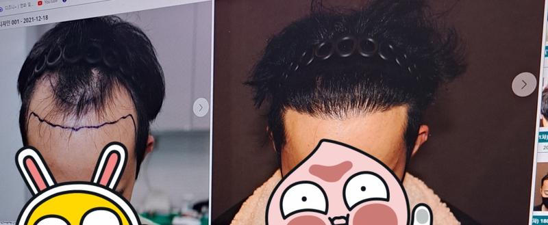 모발이식 1년 경과 사진입니다.