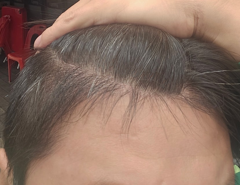 1300모낭 비절개 5개월