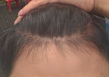 1300모낭 비절개 5개월