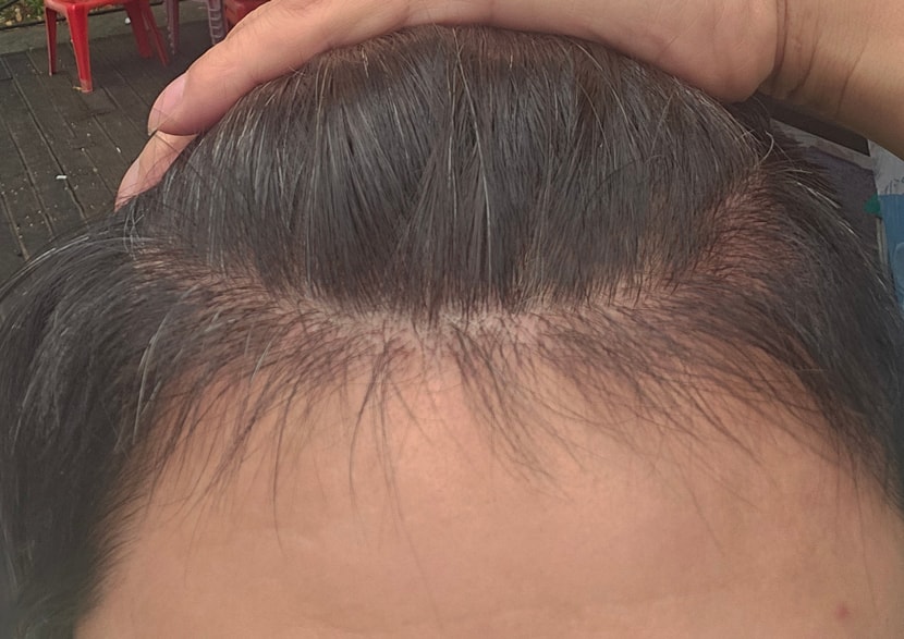 1300모낭 비절개 5개월