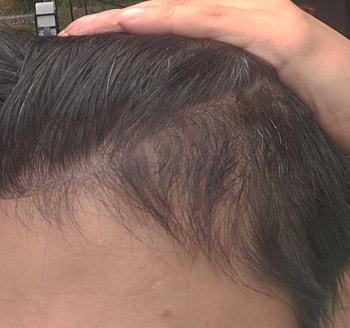 1300모낭 비절개 5개월