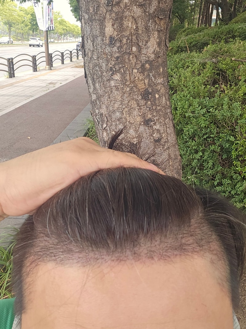 一个月前非切开种植的1300毛囊状态