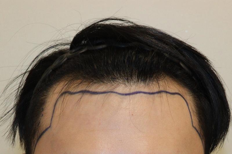대구 헤어로의원 비절개 2000모 모발이식 9개월 후기
