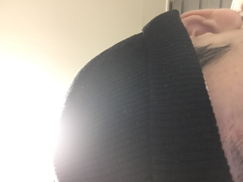 비절개 모발이식 수술및 후기 (팩트)