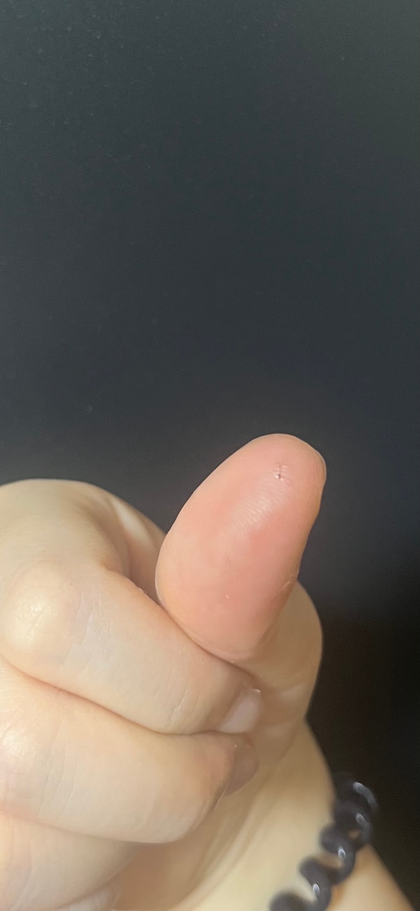 볼때기에 묻어있길래 봤는데 탈락모인가요?