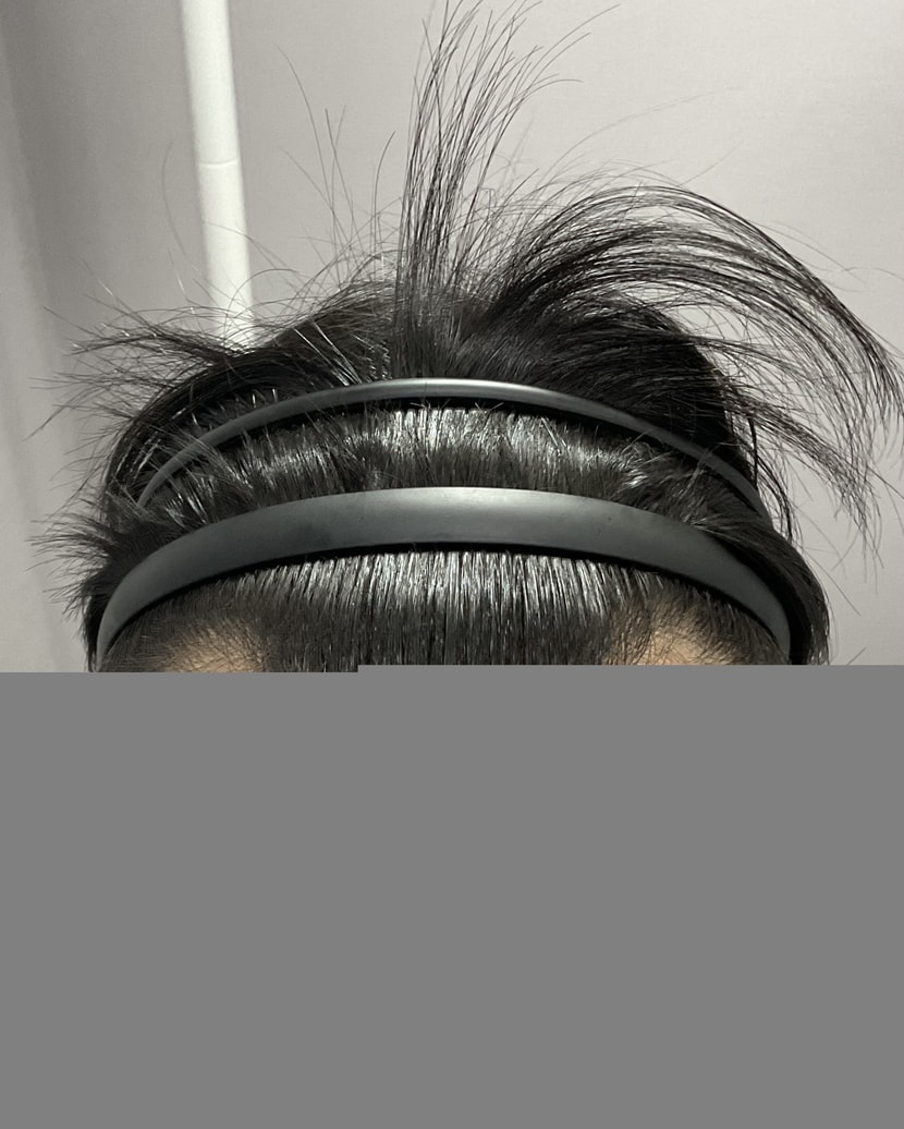 이식전