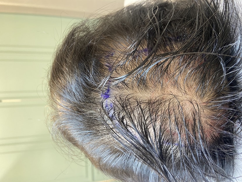 두피문신 전 전검 사진