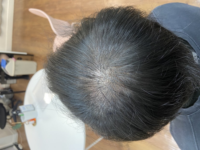 두피문신 후 사진