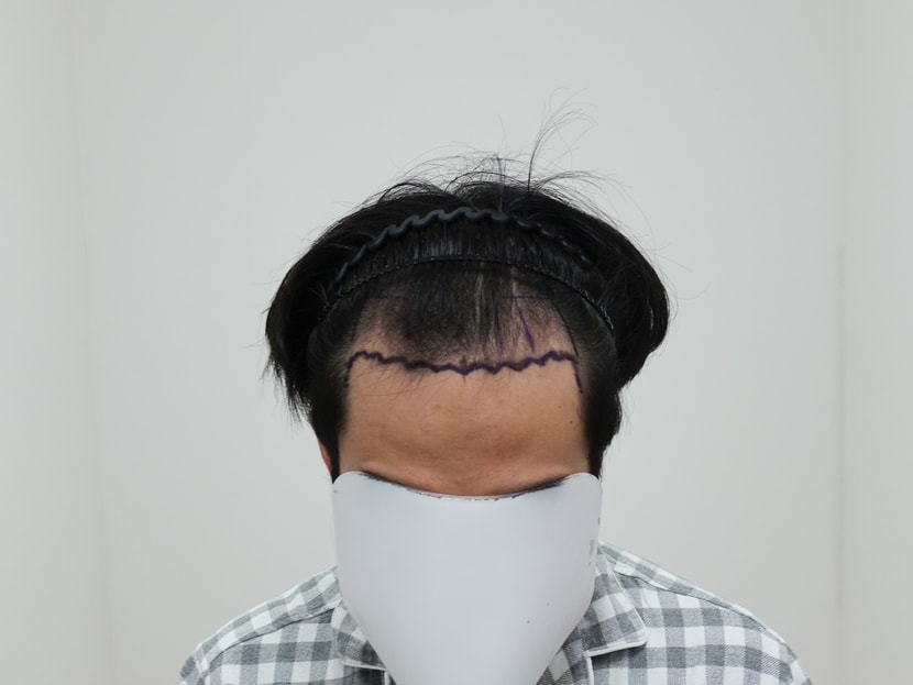 수술전