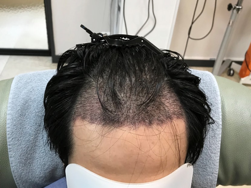 2주차 딱지제거전