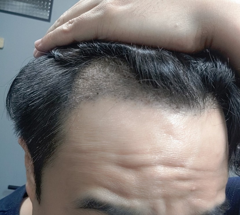 2.수술 몇일 후