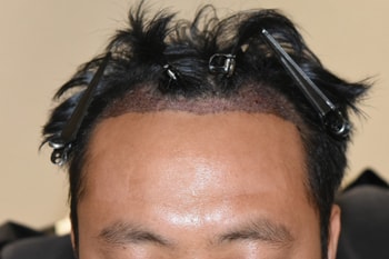 수술후