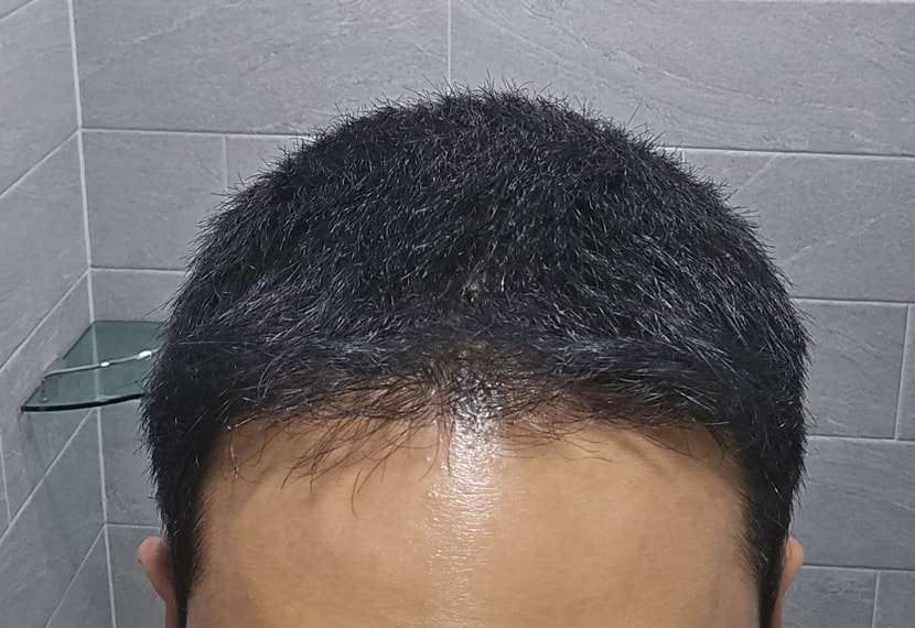 후