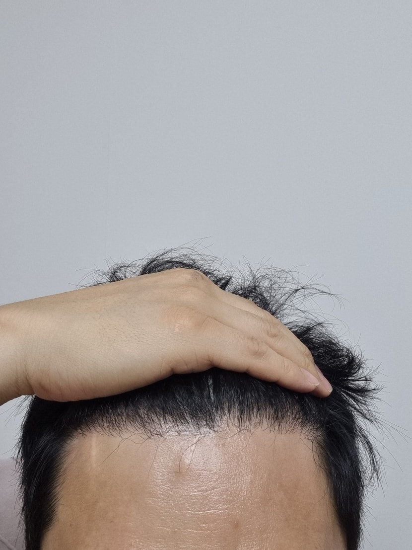 후