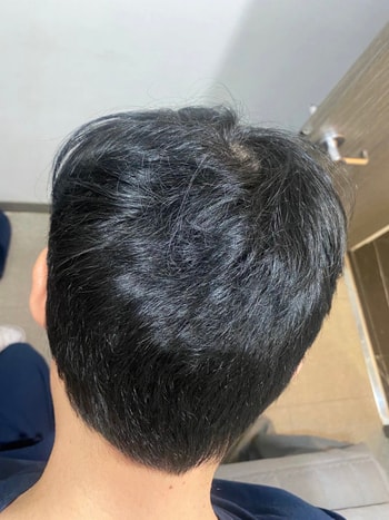 다행히 뒷머리 숱은 이식하기엔 적합하다 판단