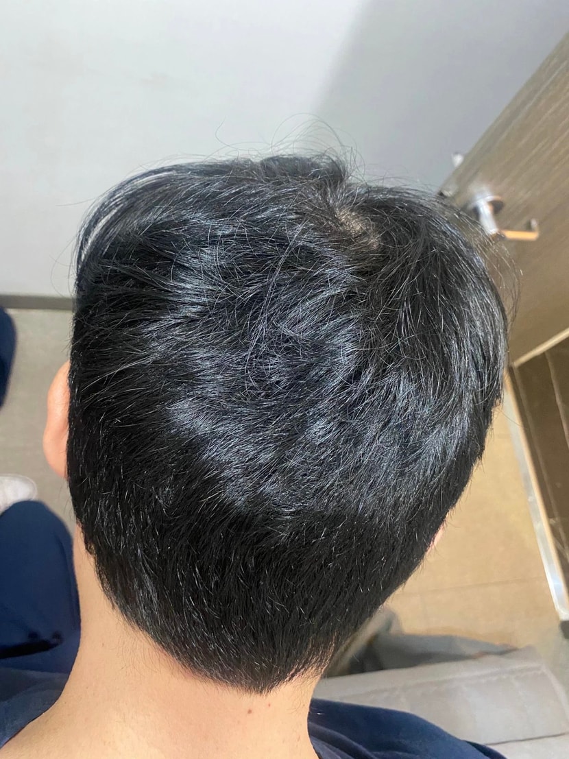 다행히 뒷머리 숱은 이식하기엔 적합하다 판단