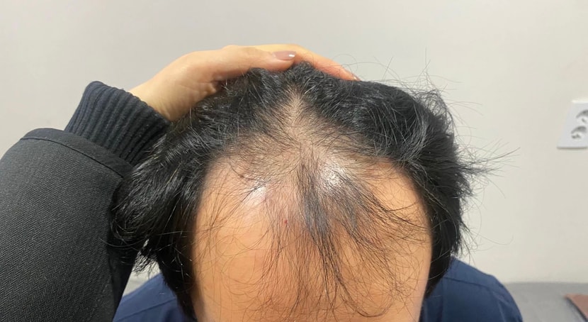 비포. 고민이 가장 컸던 앞쪽 이마부분