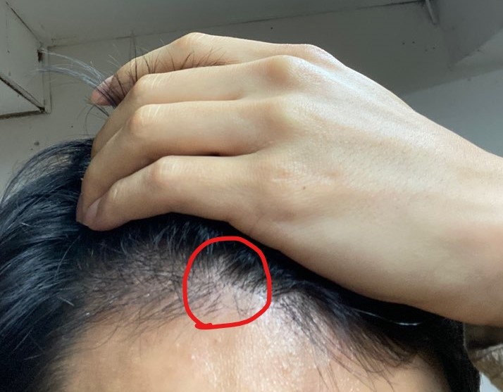 거슬리는 땜빵 