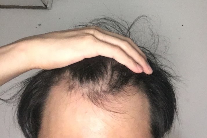 수술 전 