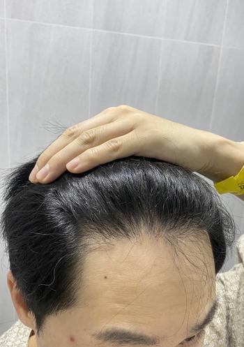 이식 전