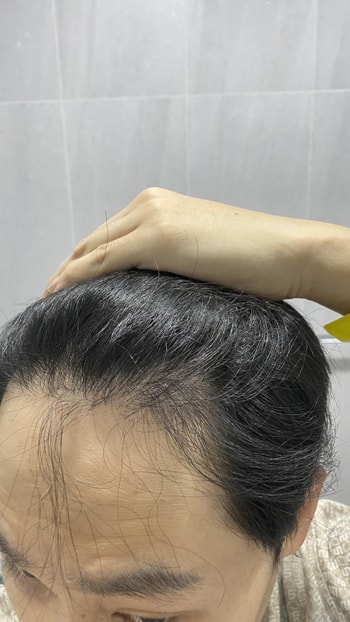 이식 전