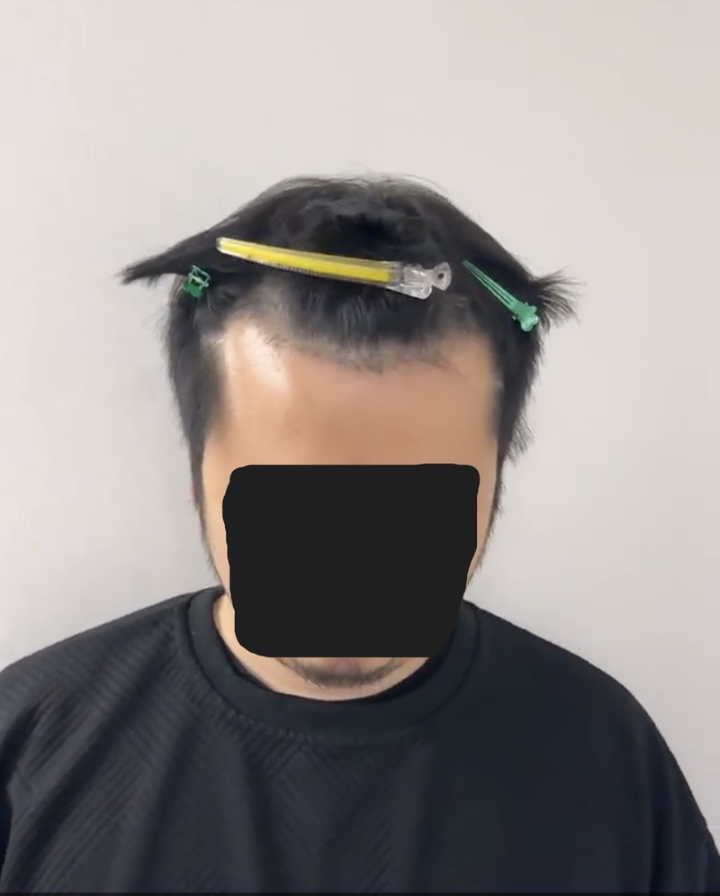 30代 キム·ポッカ 植毛 リアル体験談 4月1日移植 - 写真付き