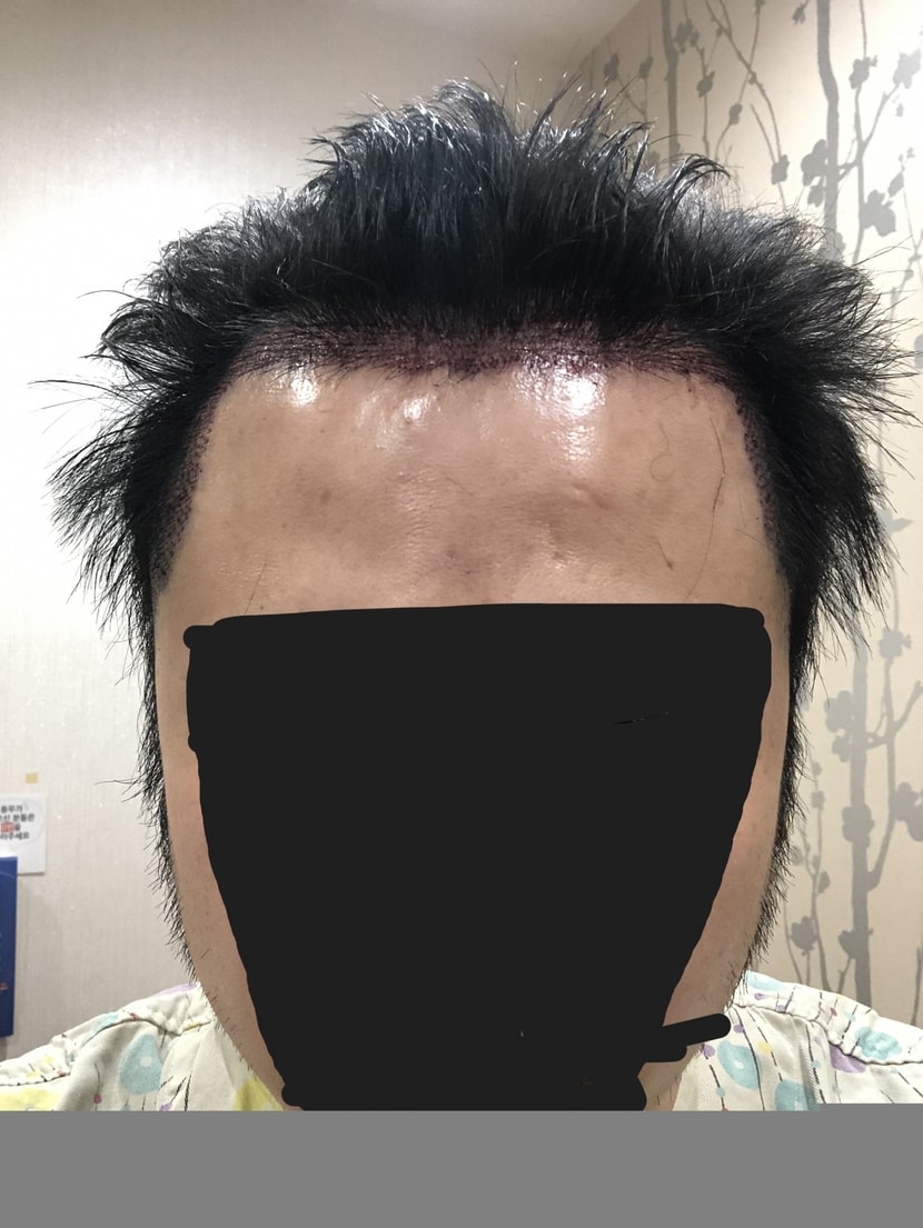 수술후