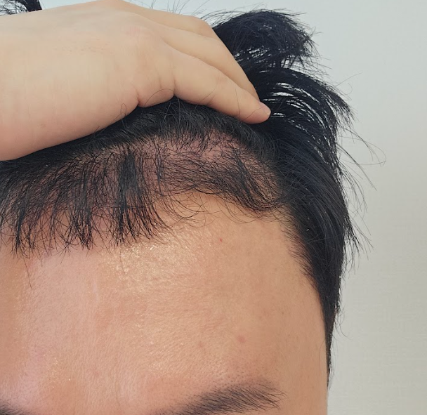4개월차 경과 괜찮나요?