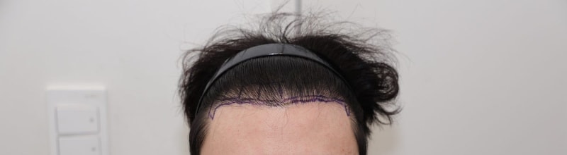 뉴헤어 서울점 / 절개 모발이식 2000모낭 (4000모) 3개월차 후기입니다.