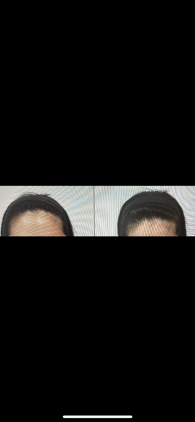 MoM Clinic Women's Hairline Transplantation (Recommended Lee Young)
