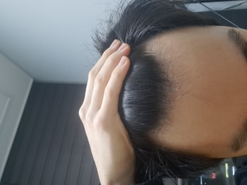 수술 전