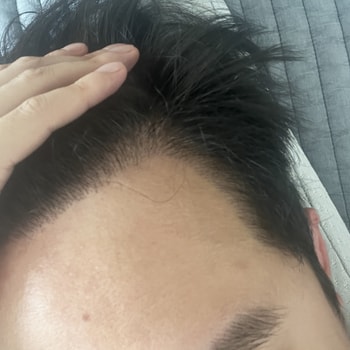 203일 경과 (우측)