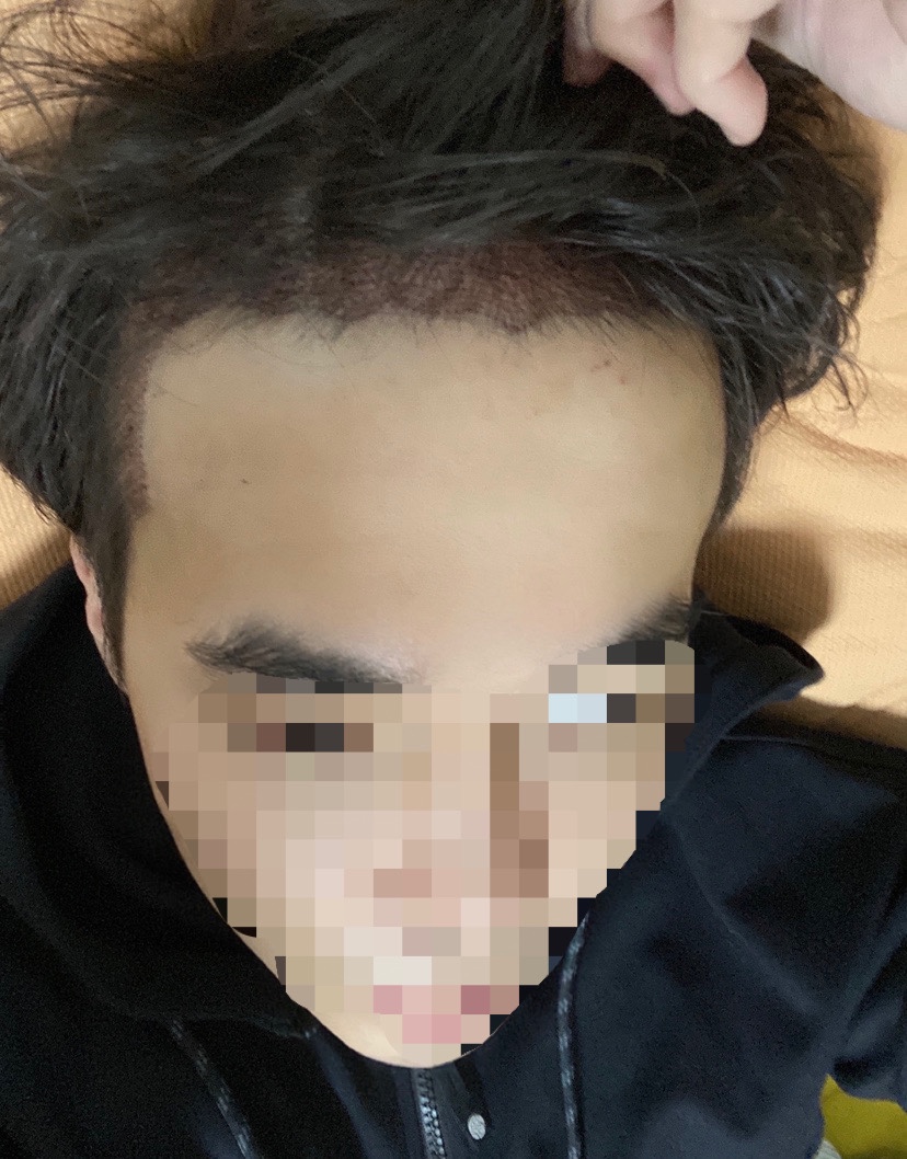 모발이식 이틀 뒤