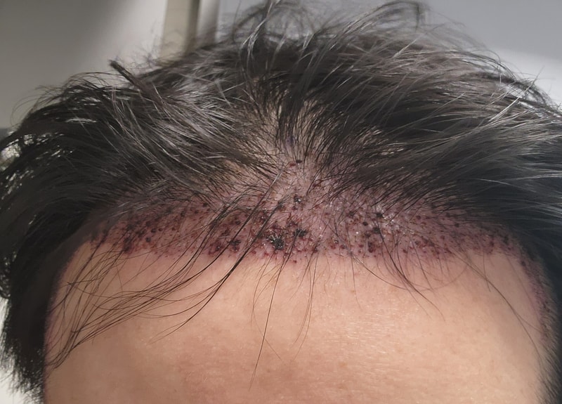 모발이식 7개월차 사진입니다