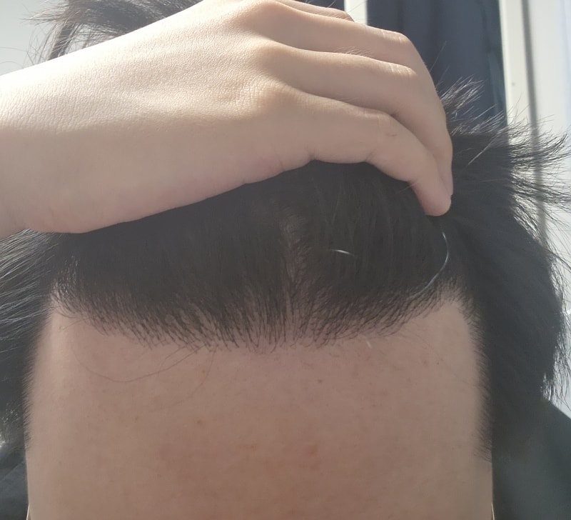 모발이식 8개월차 사진입니다