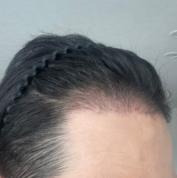 3개월 경과 헤어라인