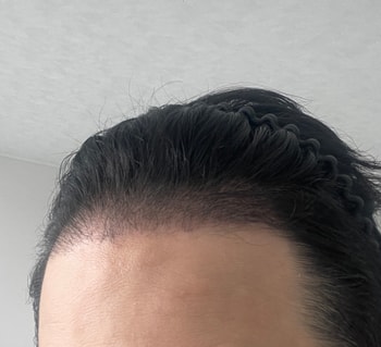 3개월 경과 헤어라인