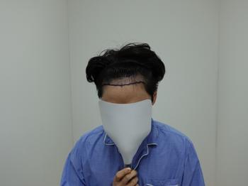 1년전 수술전 넓은 이마와 살짝 m자 모습이 있던 때